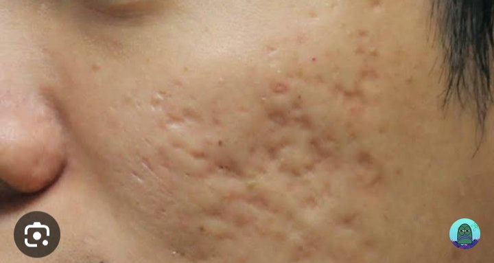 💚 Hallo gaiss, ada yg tau cara ngatasin kulit kaya gtu ga? Need information bangettt, kasih tau dong bagi yg tau hihii🙏 (Pict dr google)