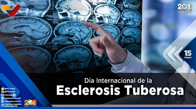 #SomosPuebloDigno    
<a href="/Mippcivzla/">mippci</a>
La Esclerosis Tuberosa o Complejo de Esclerosis Tuberosa es una enfermedad rara, incurable y poco conocida. Cada #15May se busca reconocer la importancia de este trastorno genético poco frecuente que afecta a miles de personas en el mundo.