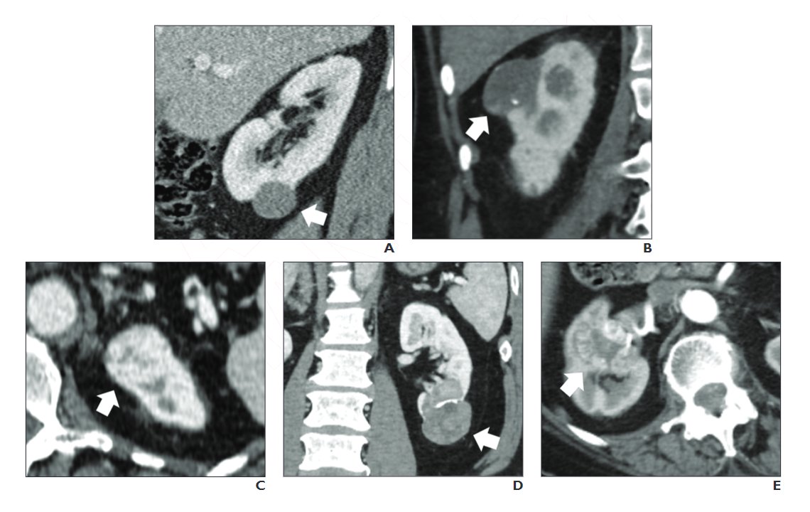 The 5-tiered CT algorithm for evaluation of small solid renal masses was tested in an external sample and showed high NPV for clear-cell renal cell carcinoma. ajronline.org/doi/abs/10.221…