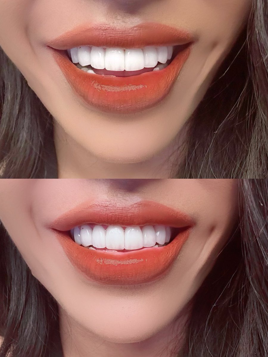 lovelmc112's tweet photo. ฟันสวยแบบดารา เซรามิกวีเนียร์
 finally ended veneer Ceramic ❤️

#dentalphotography #smiledesign
#digitalsmiledesign #aesthetics #smile #ceramicveneer
#veneer #วีเนียร์ #bangkok #dentist
#smilemakeover #beforeandafter
#dsd #3D #dentistry
#design #วีเนียร์เซรามิก #เซรามิกวีเนียร์ https://t.co/jExzLgX6hX