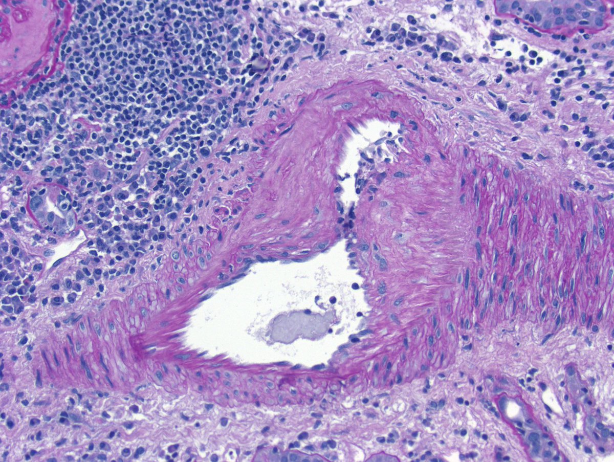Examples of acute T cell-mediated rejection findings: tubulitis and endotheliitis. This case had a good number of eosinophils, but patient history of non-compliance and endotheliitis (no abx use) strongly favors rejection rather than drug allergy #RenalPath