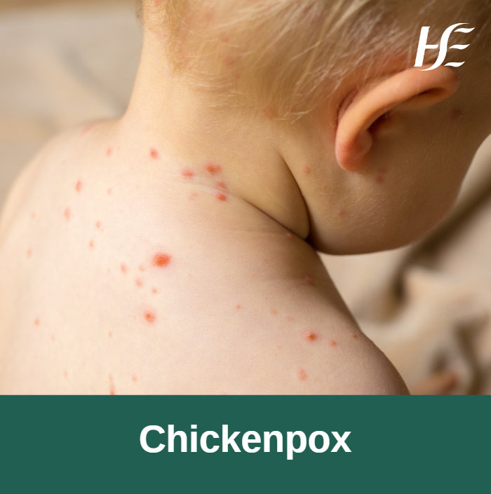 #Chickenpox is a common infectious disease that mostly affects children under 10. It can be dangerous for pregnant women and babies, so try to avoid contact with others if you think your child has chickenpox. Find out how to treat symptoms of chickenpox: bit.ly/3I7saFh