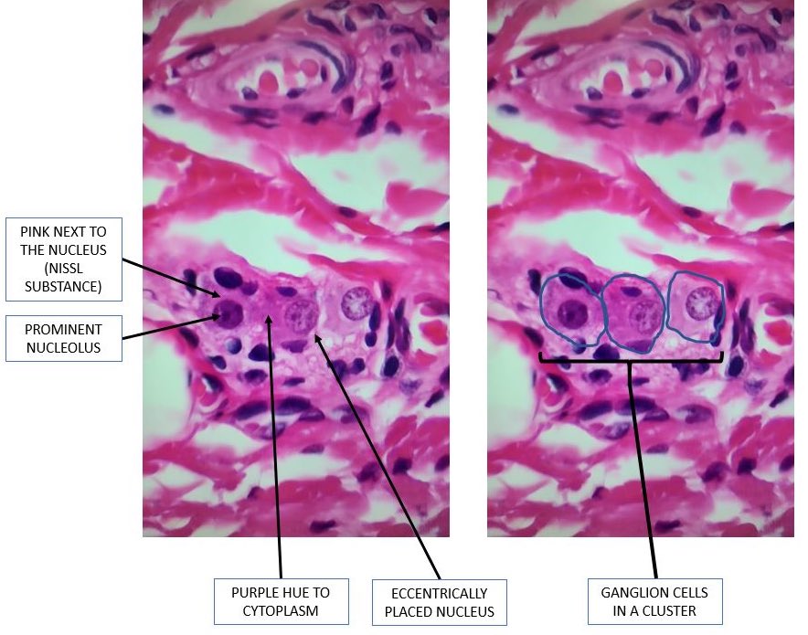 Marc Levitt (@marclevittmd) on Twitter photo What’s a ganglion cell? They tend to form clusters, there is pink next to the nucleus (Nissl substance), the nucleolus is prominent, the nucleus is eccentrically located, and there is a purple hue to the cytoplastm. <a href="/ChildrensNatl/">Children's National Hospital 🏥</a> www.Children’s national.org/departments/co… What’s a ganglion cell? They tend to form clusters, there is pink next to the nucleus (Nissl substance), the nucleolus is prominent, the nucleus is eccentrically located, and there is a purple hue to the cytoplastm. <a href="/ChildrensNatl/">Children's National Hospital 🏥</a> www.Children’s national.org/departments/co…