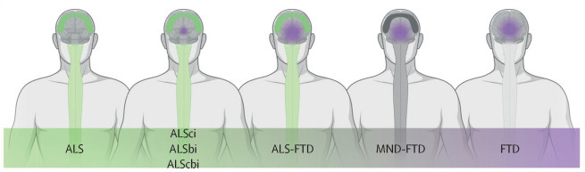 EvaFeldmanMDPhD's tweet image. Next fact that people should know about #ALS from my @TheLancet seminar...

In addition to muscle weakness, up to 50% of patients with ALS can also present with changes in cognition and behavior. #ALSAwarenessMonth