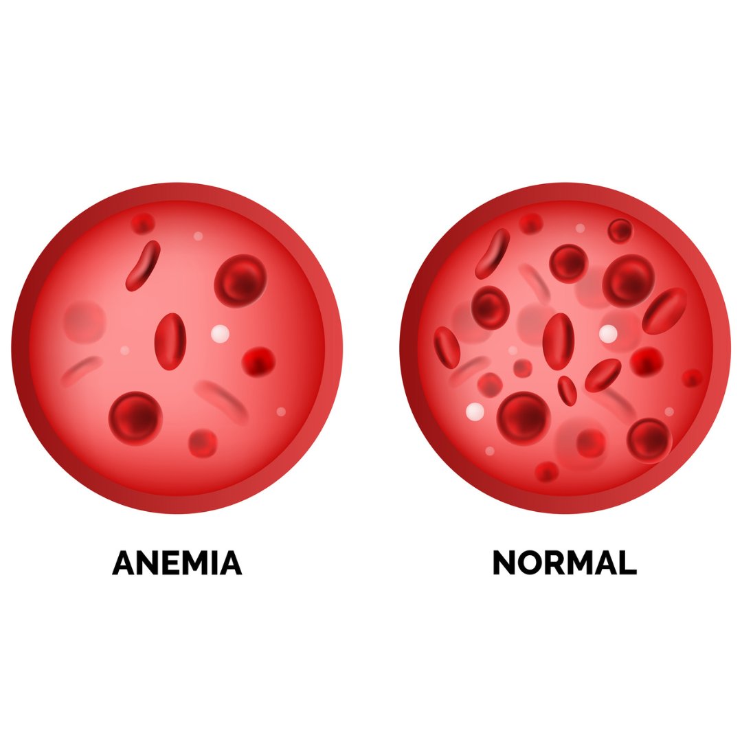 Optiferiron's tweet photo. Anemia affects millions worldwide, causing fatigue, weakness, and shortness of breath. Understanding its types and underlying causes is key to effective treatment. https://t.co/mS9bBUpSaH