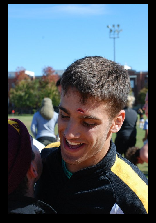 just Italian on Twitter "I had gotten my stitches out 24 hr earlier