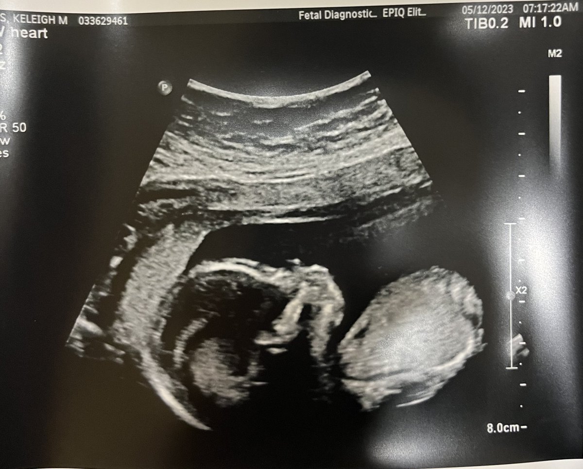 KeleighAnders's tweet photo. Phew, this #pregnancy has been a rough one with ongoing issues from a very large #subchorionichematoma. But we are doing alright today! 16+ weeks with this lil hitchhiker I’m transporting & supporting for his parents as a #gestationalsurrogate https://t.co/CUw1q3O2K1