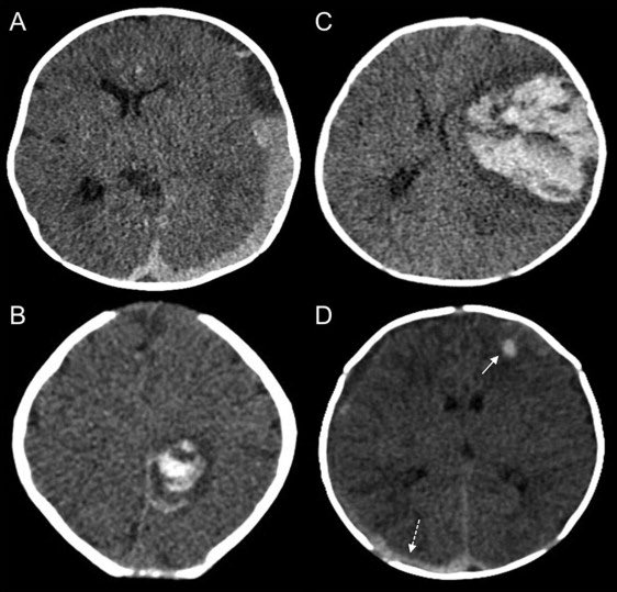 Vitamin K isn’t a vaccine. 
Vitamin K doesn’t cause autism. 
Vitamin K prevents catastrophic neonatal brain bleeding. 

sciencedirect.com/science/articl…