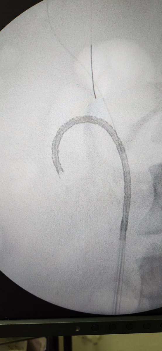 Dr Ignacio Costabel (@costabeldr) on Twitter photo Cáliz inferior con ángulo agudo. Mejor usar descartable como en este caso <a href="/PusenMedical/">Pusen Medical</a>
<a href="/so_uro/">UroSoMe</a>
Dificult lower pole calix. Better use disponible. <a href="/PusenMedical/">Pusen Medical</a> Cáliz inferior con ángulo agudo. Mejor usar descartable como en este caso <a href="/PusenMedical/">Pusen Medical</a>
<a href="/so_uro/">UroSoMe</a>
Dificult lower pole calix. Better use disponible. <a href="/PusenMedical/">Pusen Medical</a>