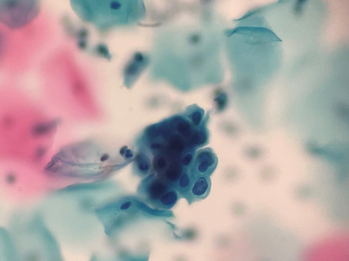 PAP SMEAR (SurePath™) For more information visit: https://t.co/AKR4dsKhqh