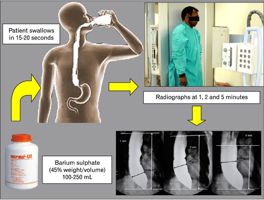 The Koshur Doc on Twitter "“When Barium goes down the wrong pipe” Barium sulphate aspiration