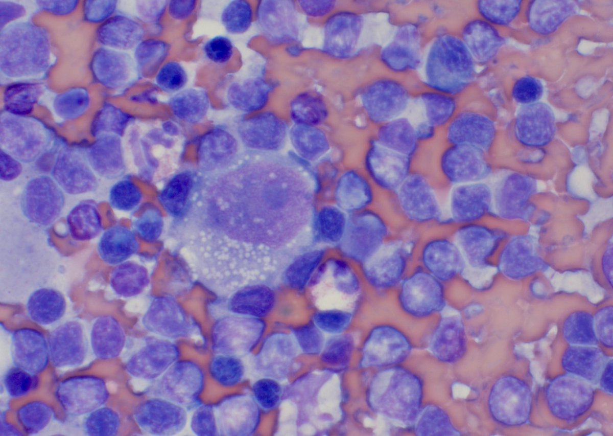 AmirBehdadMD's tweet photo. Sometimes just the touch preps are enough for the diagnosis! #hemepath @CleveClinicFL @CLEClinicLabs https://t.co/YzHXX4HEXn