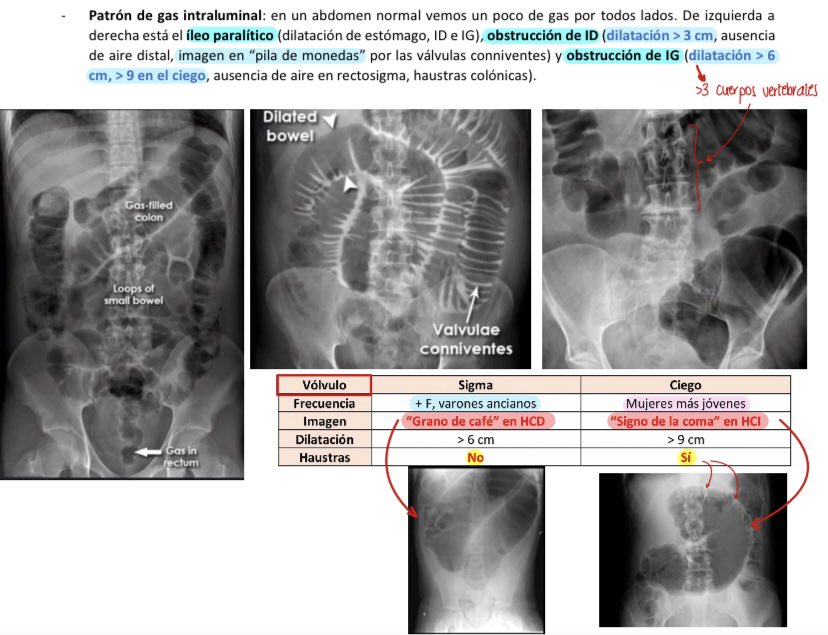 Valvulae Valvulas Conniventes Obstrucción Intestinal Durante La Convalecencia