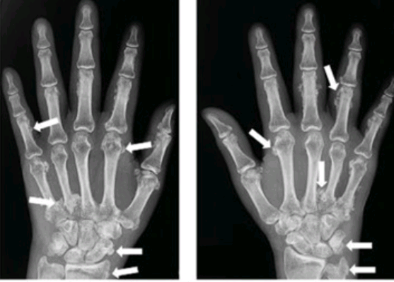 reinmd77's tweet photo. 40yo♂️diffuse arthralgia widespread.
++⚡Hand edema, pitting
🎞️!
🔑Voriconazole /transplant liver&amp; kidney 
◾Voriconazole-Induced Periostitis
💊🛑:2 days later😀
https://t.co/uoDB7IOygh https://t.co/0o5JWJXF9Q