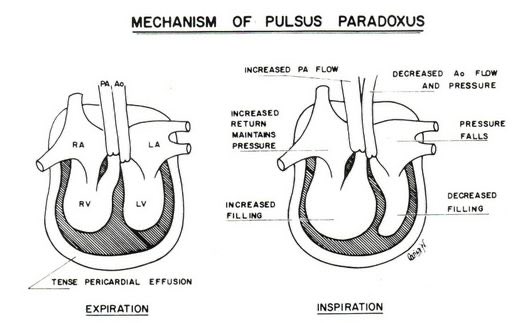 What is meant my Pulsus Paradoxus ?
A one-stop pathophysiology thread you’d ever need 🧵

#MedTwitter #MedStudentTwitter #MedEd #FOAMed #CardioEd #USMLE #ICU #EMTwitter