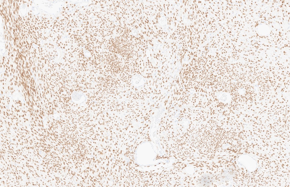 MEArslanMD's tweet photo. SS18-SSX immunostain. The diagnosis is synovial sarcoma (presenting as colon polyp). It's one of the rare cases. @sohn_aaron @w_path @pembeoltulu @EricMadPatho @327dfj @frances13690 @IAbukhiran https://t.co/2FItZeEKA8