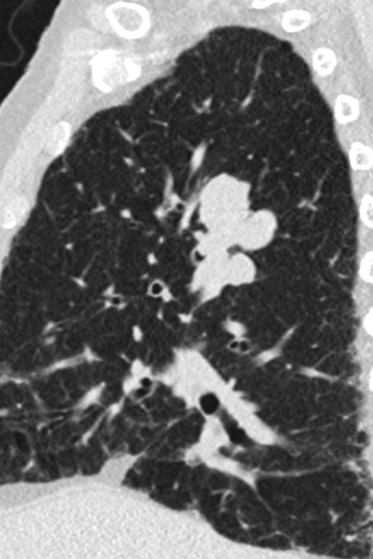 @MountSinaiChestRadiology (@mountsinaichest) on Twitter photo Haven't seen this too many times.
Endobronchial spread of primary SCC
<a href="/MountSinaiDR/">Mount Sinai Radiology Residency</a> <a href="/MountSinaiDMIR/">Mount Sinai Diag, Molecular, and Interv Radiology</a> <a href="/RofskyMD/">Neil Rofsky, MD, MHA</a> <a href="/STS_CTsurgery/">The Society of Thoracic Surgeons</a> <a href="/thoracicrad/">Society of Thoracic Radiology</a> Haven't seen this too many times.
Endobronchial spread of primary SCC
<a href="/MountSinaiDR/">Mount Sinai Radiology Residency</a> <a href="/MountSinaiDMIR/">Mount Sinai Diag, Molecular, and Interv Radiology</a> <a href="/RofskyMD/">Neil Rofsky, MD, MHA</a> <a href="/STS_CTsurgery/">The Society of Thoracic Surgeons</a> <a href="/thoracicrad/">Society of Thoracic Radiology</a>