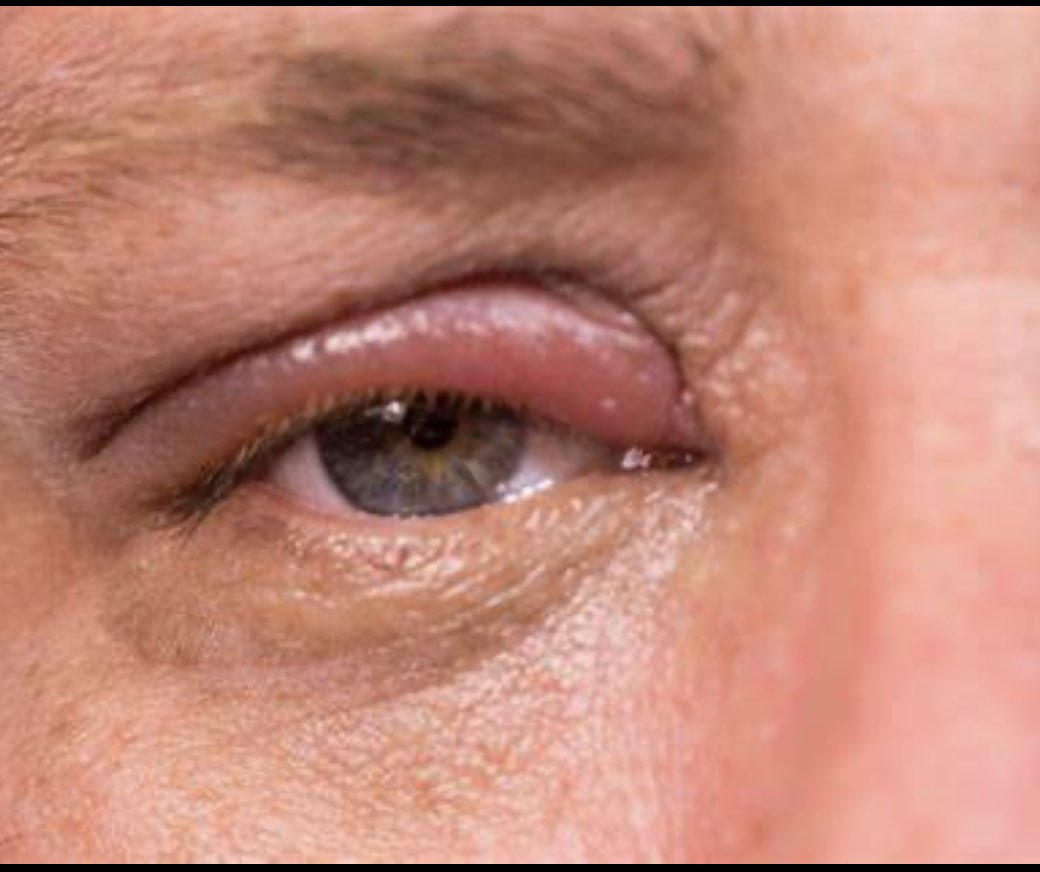 with_out_a_crystal_ballz on Twitter "Omg this bish has a chalazion or