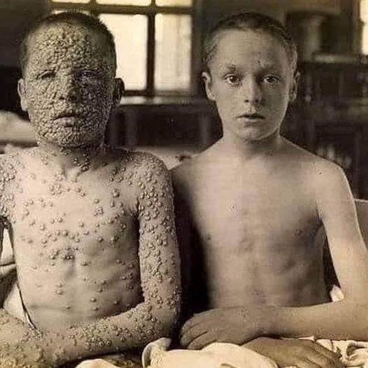 Ein Bild sagt mehr als Tausend Worte: So sieht ein Impfdurchbruch bei Pocken aus!
Junge rechts: geimpft
Dieses Foto wurde 1901 von Dr. Allan Warner im Leicester Krankenhaus (UK) aufgenommen.