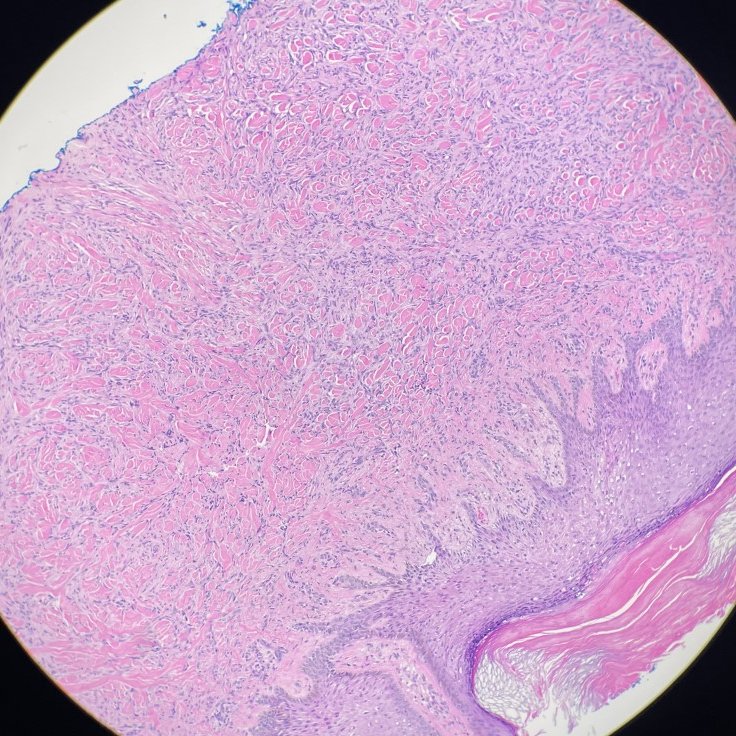 megothelioma's tweet photo. In a dermatofibroma, you can see collagen trapping by a fibroblastic/histiocytic spindle cell population.
#DermPath #PathTwitter #PathResidents #BasicPath #MedTwitter https://t.co/wODU6zM0oE