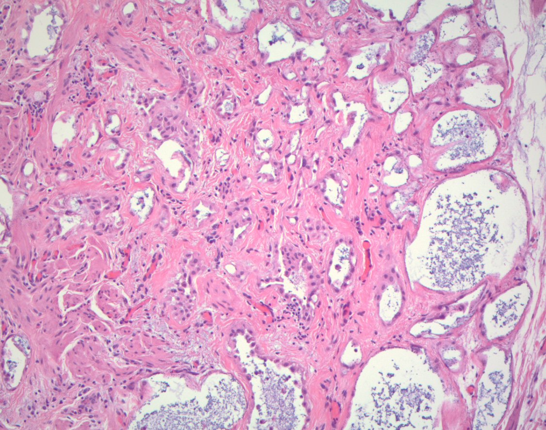 Megan Smith on Twitter "Incidental finding in a tubal ligation