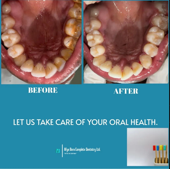 afyaboradentist's tweet photo. #scalling and root planing is the best option for a wonderful smile🔥welcome at Afya Bora Complete Dentistry Ltd for an amazing smile https://t.co/IyuVwML8YB