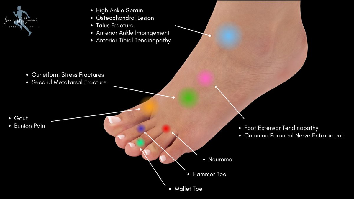 🦶Our Updated Differential Diagnosis around the Foot🦶 

*These pictures don’t represent the exact location of pain, the purpose is to increase people’s awareness of potential diff Dx*