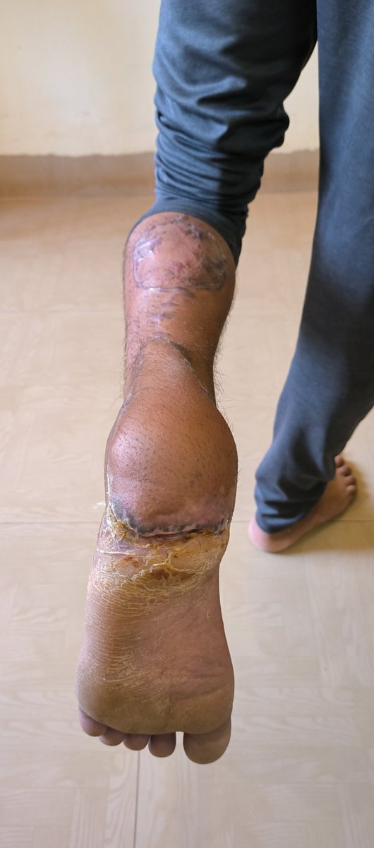 arunjeedi's tweet photo. RSF- Reverse sural flap. How often do we see such a nicely settled flap over heel. 

#MedTwitter #plasticsurgery #orthotwitter https://t.co/3b7Um4VNMz