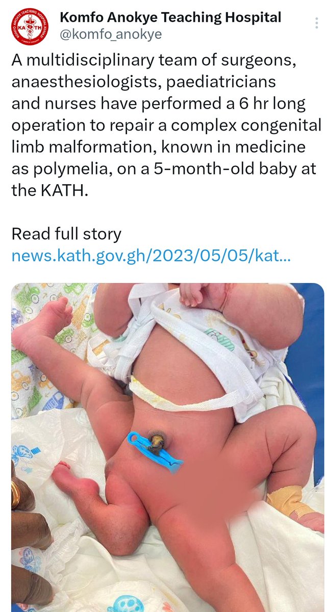 AfricaFactsZone's tweet photo. A Ghanaian Team of Surgeons, Anaesthesiologists, Paediatricians and Nurses have performed a complex congenital limb malformation operation on a 5-month baby.

The 6-hour long operation was led by Dr. Dominic Konadu-Yeboah at Komfo Anokye Teaching Hospital in Kumasi. https://t.co/M3udZvBGSB