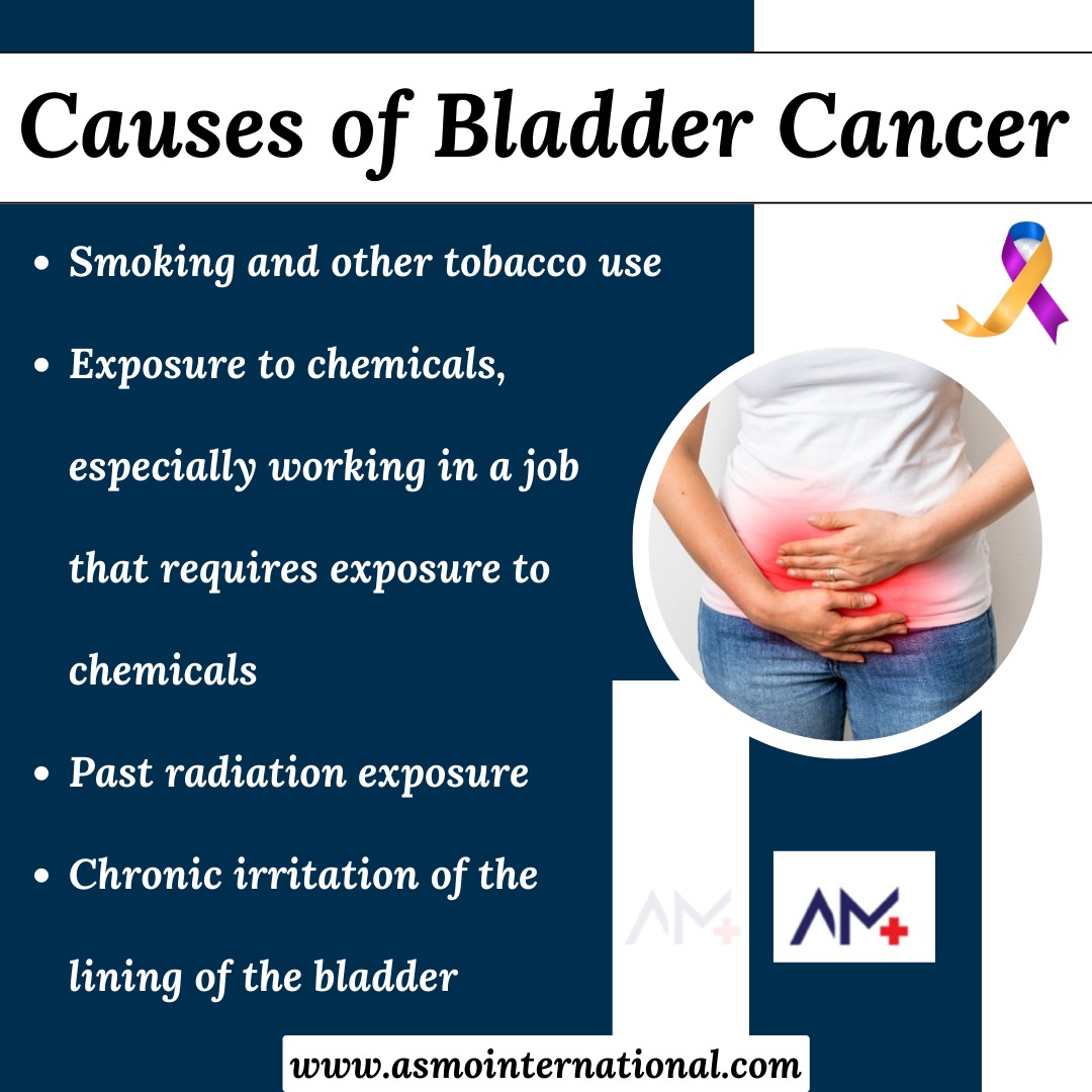 Causes of Bladder Cancer
.
bit.ly/3nHERKo
.
#bladdercancer #cancer #urology #prostatecancer #kidneycancer #health #cancerawareness #urologist #lungcancer #bladder #bladdercanceraware #healthcare #asmointernational #asmohealth #asmomedicines #asmocare #asmoresearch #asmo