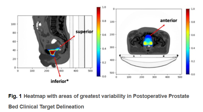 ESTRO Guideline on Prostate Bed Delineation for Postoperative Radiotherapy in #Prostate #Cancer, just published in <a href="/ctRO_journal/">Clinical & Translational Radiation Oncology</a> and presented this morning at #ESTRO23.
Access the article 👉 bit.ly/3Og8iUo