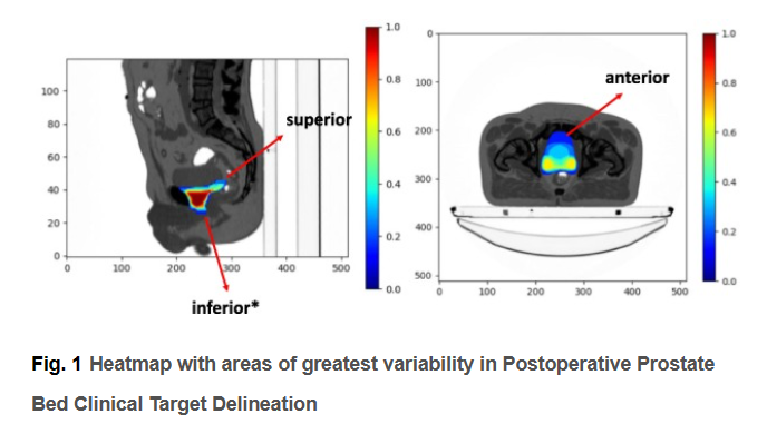 ESTRO Guideline on Prostate Bed Delineation for Postoperative Radiotherapy in #Prostate #Cancer, just published in @ctRO_journal and presented this morning at #ESTRO23. Access the article 👉 bit.ly/3Og8iUo