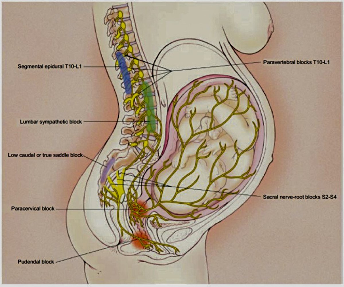 AJOG Expert Review in Labor:  Pharmacologic and nonpharmacologic options for pain relief during labor: an expert review - Transmission of labor pain. Labor pain has a visceral component and a somatic component ow.ly/oIc650NTqKu