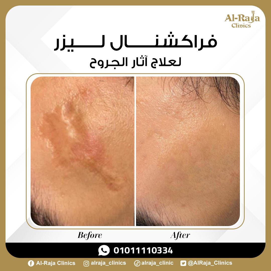 PanoramaClinics's tweet photo. ✨تخلص من آثار الجروح والحروق بالوجه و جميع اجزاء الجسم من خلال جلسات الفراكشنال ليزر 🍃
للحجز والاستفسار علي الرقم :
01011110334📲
#صباح_الخيرᅠ #الخير_قادم #صباح_الخير_والسعاده #يحدث_الآن #آثار_جروح #اثار_حروق #فركشنال_ليزر #ليزر_ازاله_الشعر #شفط_دهون #بلازما #شفط_دهون_بالفيزر https://t.co/ofwDauq1ur