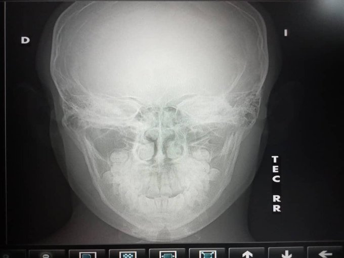InforTvenezuela's tweet photo. Jovencito con condición autista e hijo del periodista y locutor Ernesto Martinez @ErnestoM1059 ,fue víctima de bullying y de una golpiza en el liceo "Creacion" de Ocumare ,edo Miranda.
El locutor denuncia que fueron estudiantes de 4to y 5to año de bachillerato.
@Tarekwilliamsaab https://t.co/abSHc0Kdex