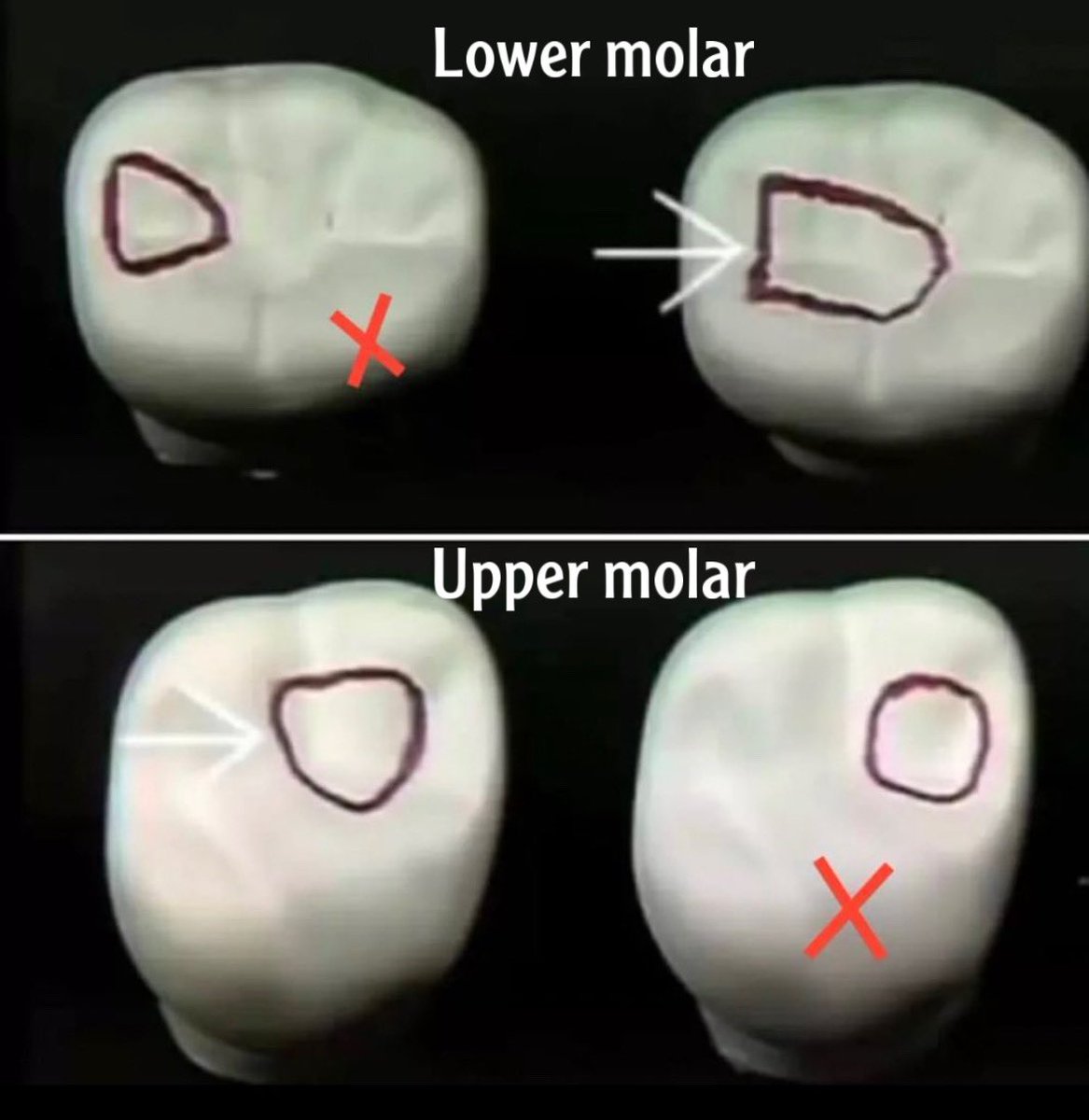 Location of access cavity of upper and lower molars.