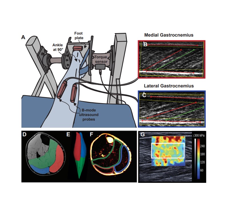 #ArticlesInPress “Influence of internal muscle properties on muscle shape change and gearing in the human gastrocnemii”
Nicole Y. Kelp, et al. 
ow.ly/xzJI50OlXt8
#JAPPL #stiffness #ultrasound #aging <a href="/TaylorJMDick/">Taylor Dick</a> <a href="/NKelp/">Nicole Yvette Kelp</a> @FrancoisHug