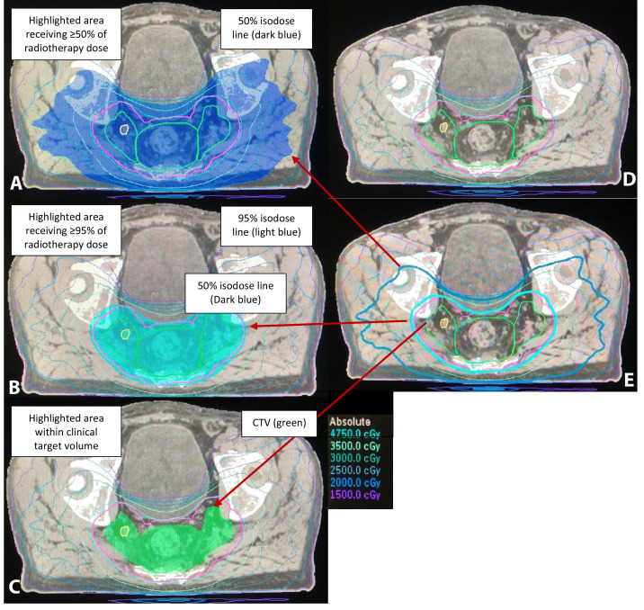 Adequate coverage of lateral lymph nodes by routine radiotherapy is associated with considerable lateral local recurrence risk. Published in #RedJournal #laterallymphnodes #colorectalresearch #radiotherapy  @TaniaSluckin @SanneHazen @MirandaKusters 
sciencedirect.com/science/articl…