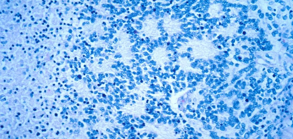TCHResearchNews (@tchresearchnews) on Twitter photo A first-in-human phase 1 clinical trial for neuroblastoma using CAR-NKT cell therapy, led by Drs. Andras Heczey & Leonid Metelitsa <a href="/TexasChildrens/">Texas Children's</a> & <a href="/bcmhouston/">BCMHouston</a>, shows promising results. More: bit.ly/3W6vx53 A first-in-human phase 1 clinical trial for neuroblastoma using CAR-NKT cell therapy, led by Drs. Andras Heczey & Leonid Metelitsa <a href="/TexasChildrens/">Texas Children's</a> & <a href="/bcmhouston/">BCMHouston</a>, shows promising results. More: bit.ly/3W6vx53
