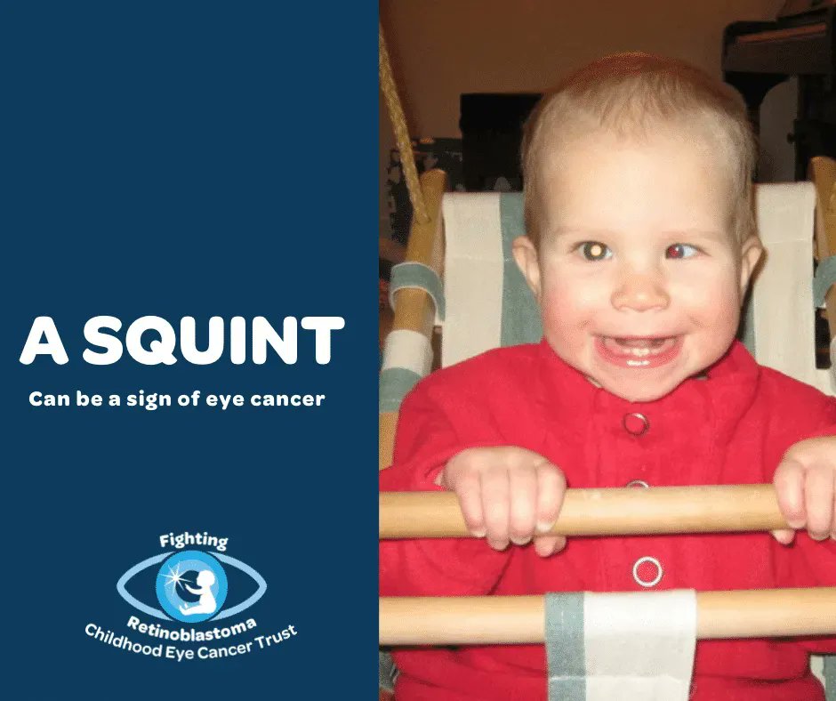 A squint, where the eyes do not look in the same direction, can sometimes be a symptom of retinoblastoma. In many cases, it’s nothing more than a squint but all children should be checked out just in case, as it’s the second most common sign of retinoblastoma  #RbWeek