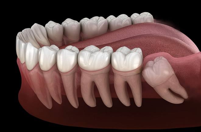 Vivekmadhvimuku's tweet photo. अक्कल दाढा #Wisdom_Teeth या मानवाच्या तोंडात सर्वात शेवटी येणारे दात असतात. ह्या १७ ते २५ या वयात दुसऱ्या दाढेच्या पलीकडे येतात. माणसाला जबड्याच्या वरच्या बाजूला दोन आणि खालच्या बाजूला दोन अश्या जास्तीत जास्त एकूण चार अक्कल दाढा येऊ शकतात. https://t.co/aiYS8zzfIZ