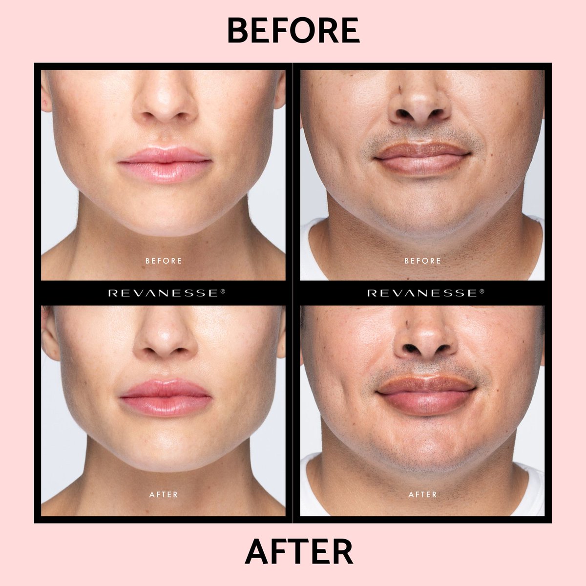 AnuMedSpa's tweet photo. Want to enhance your lip shape, or looking to add more volume? 
Revanesse Filler could be just what you're looking for!

Call the office at 856-809-0909 or head to https://t.co/JJvYXOIiCC  to book your consultation with one of our specialists! https://t.co/bk9hbocgyt