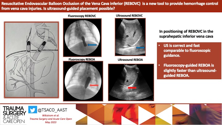 TSACO_AAST's tweet photo. #TSACOTUESDAYS! 🔥
Resuscitative endovascular balloon occlusion of the IVC (REBOVC) is a new tool to provide hemorrhage control from vena cava injuries.
Ultrasound can guide REBOVC placement in a porcine model.
For REBOA, fluoroscopic guidance is slightly faster than ultrasound.
#REBOA #TSACOGLOBAL
➡️ https://t.co/RiVfJVbxu2
