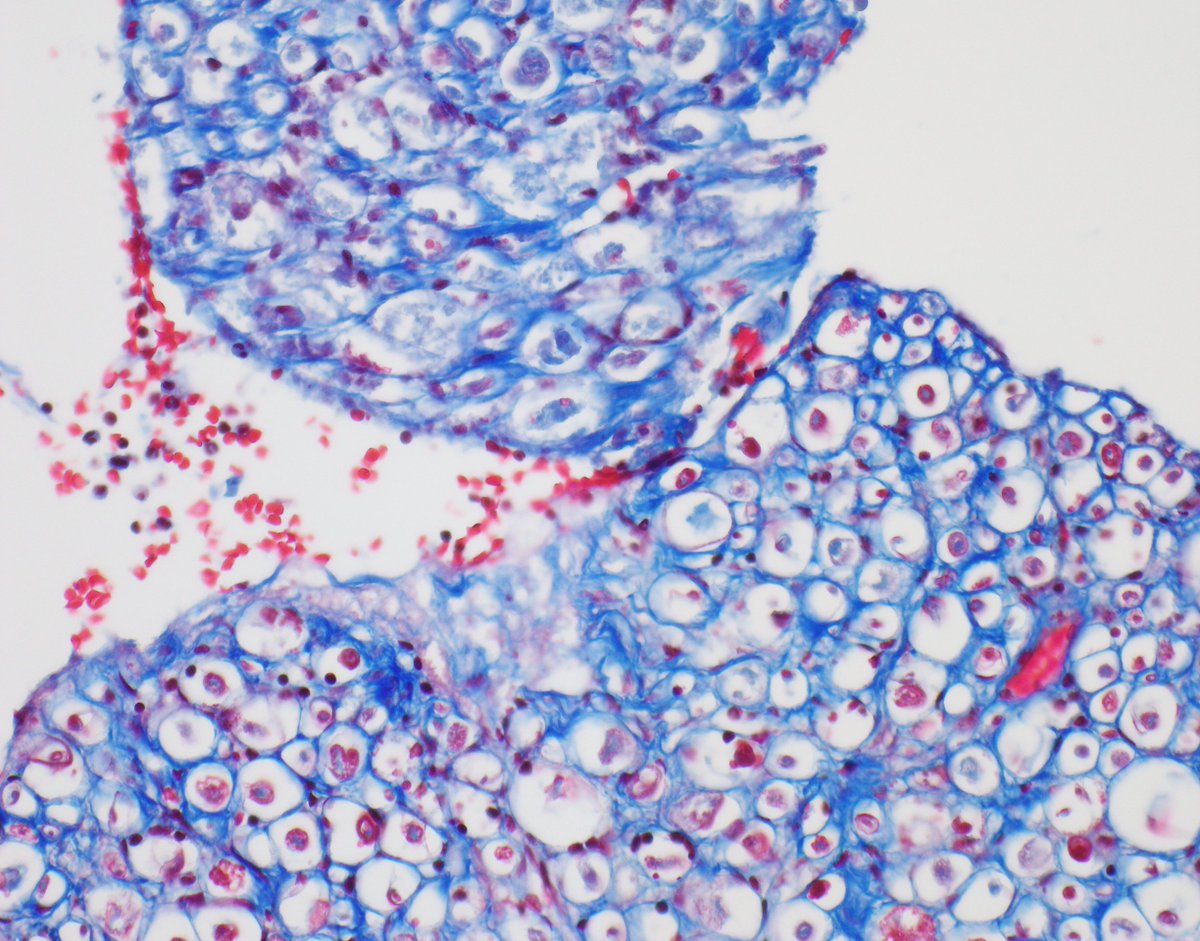 BWH Neuropathology tweet media