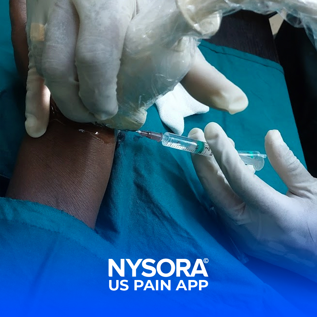 NYSORA's tweet photo. A 56-year-old male chef presented with 2 years history of right #wrist pain along with severe pain of the #radial 3 and a half fingers, increasing at night.
We just released this full case study to NYSORA's #USPain app. Download it today: https://t.co/NgursfkCH6 https://t.co/YN9knBTsWn