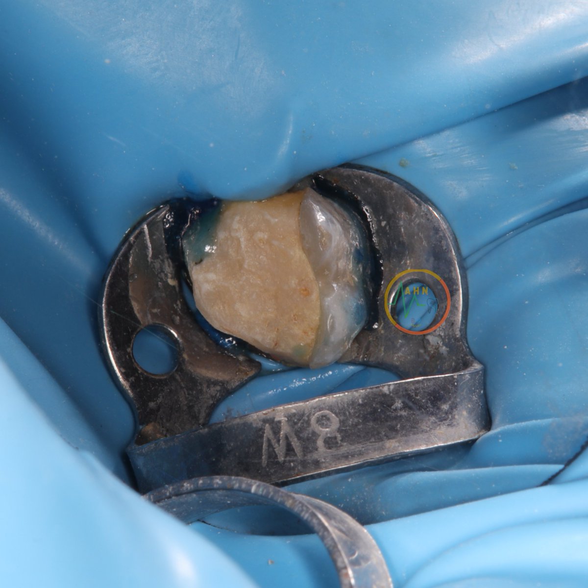 dentist_amar617's tweet photo. اعادة علاج عصب لطاحن علوي مع تركيب دعامة
Re rect for #16. after removal of old restoration and the remaining structure were little, post were decided to be placed after re rct
#saveatooth #endodontics https://t.co/9IHZ2T1V2B