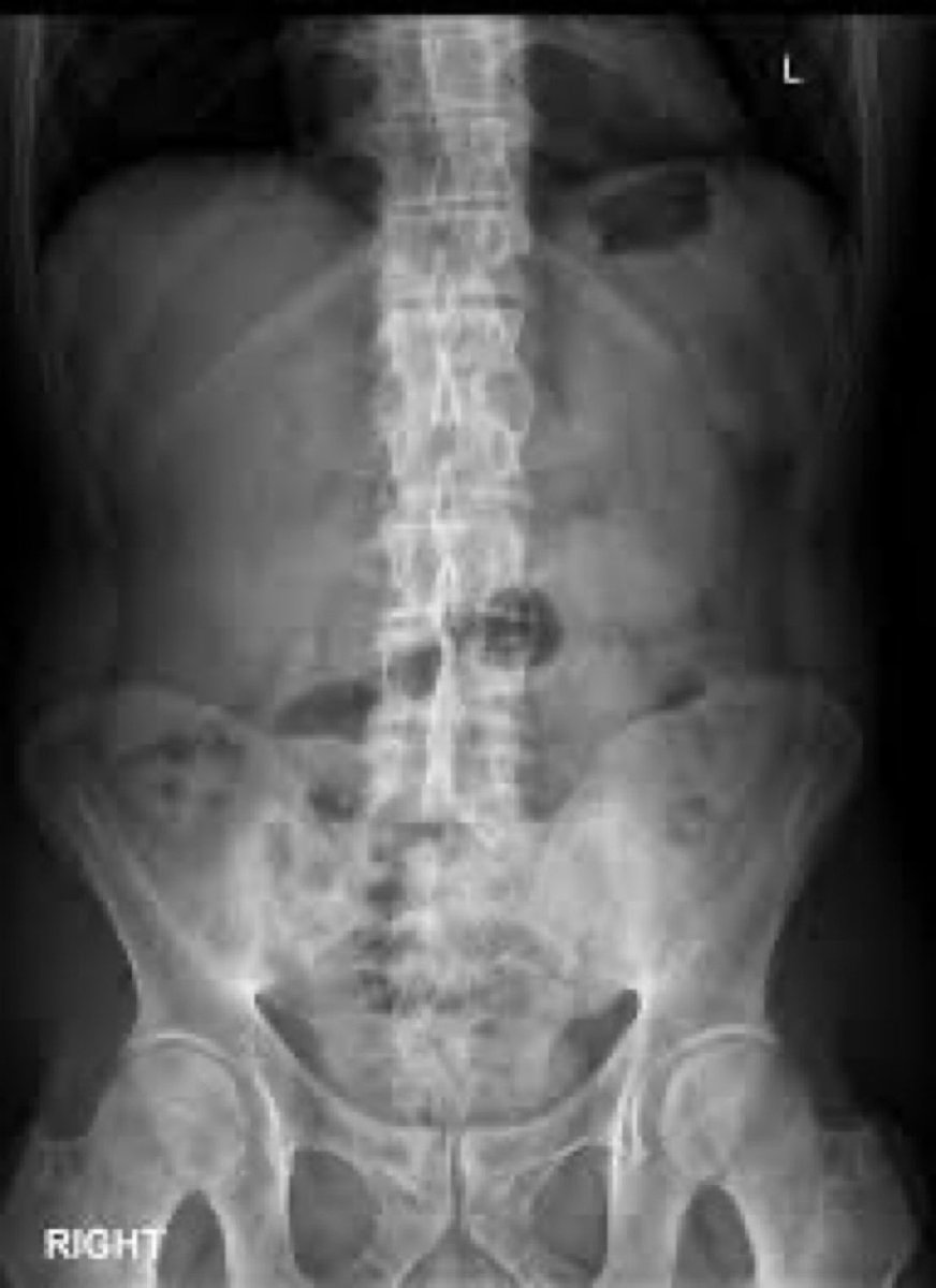 BrownJHM's tweet photo. A man in his 30s with hx of Crohn’s came with right shoulder &amp; wrist pain w/ ⬇️range of motion. He also stated having low back pain which improves with exercise &amp; aggravated at night. X-ray w/bamboo spine appearance. What is the likely diagnosis, next tests? #MedTwitter https://t.co/m9QzCjWdKw