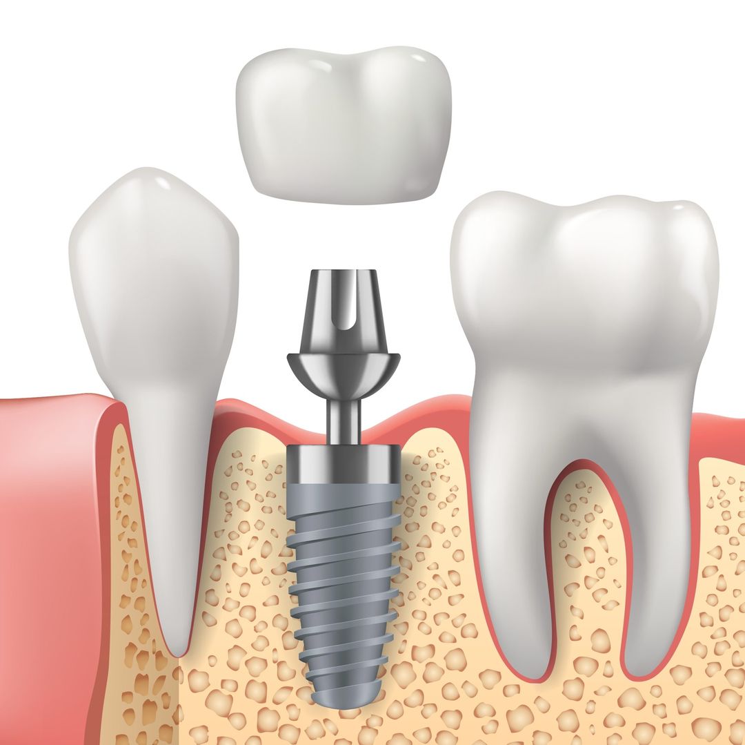 RiiliStudio's tweet photo. Cosa si intende per abutment?
In implantologia con il termine abutment si indica la componente protesica che viene inserita sull’impianto dentale e sopra la quale viene cementata la corona protesica. 
#Abutment #ImpiantoDentale #PazientiInformati
#StudioDentisticoRiili
#ANDI https://t.co/oyygX7DJTU