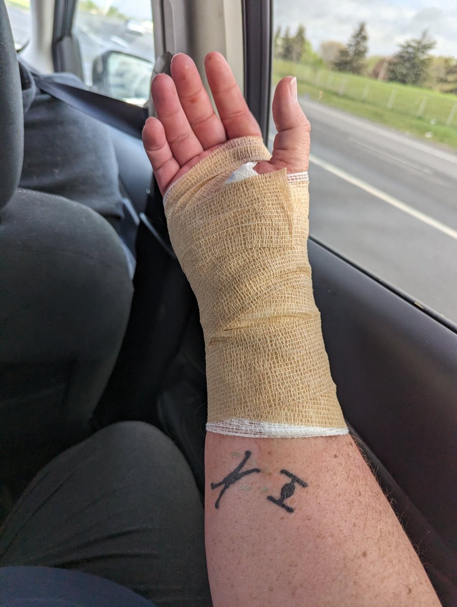 2 years after breaking my wrist, it was a successful operation today!!!