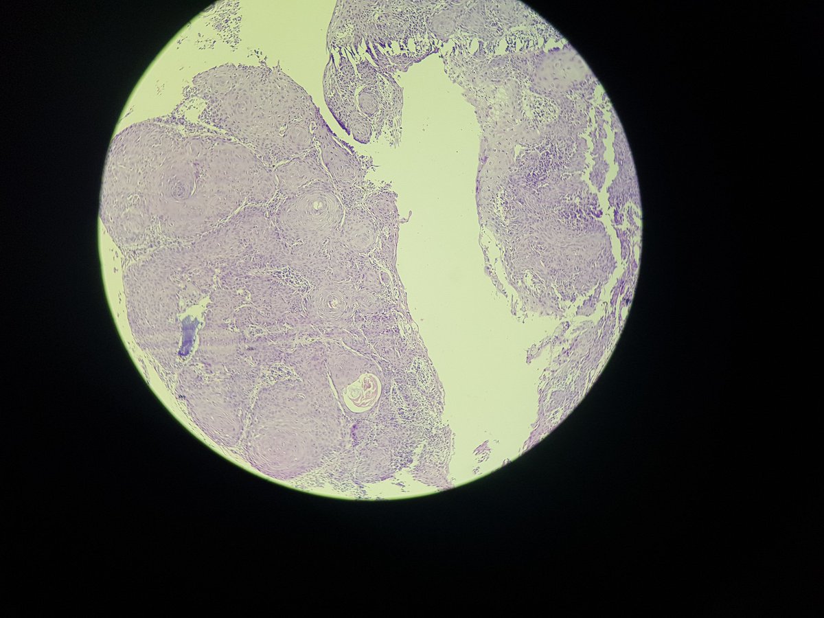 AlaaRowaid_88's tweet photo. 🔬 30 yrs old male with lesion on the tip of the nose 
🔬 is it IFC or Well differntiated SCC ? 
#Pathology 
#skin pathology https://t.co/Vdb34Ox3tG